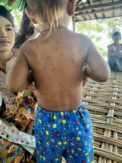 ကျောက်တော်နယ်မှ စစ်ရှောင်စခန်း (၂)ခုတွင် ကလေး(၁ဝ)ဦးခန့် အရေပြားရောဂါဖြစ်နေ