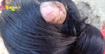 ကျောက်တော်မြို့နယ် စစ်ရှောင်စခန်းမှ မြိုအမျိုးသမီးတစ်ဦး၏ ဦးခေါင်းအနာဖုကိုခွဲစိပ်ရန် အကူအညီလိုအပ်နေ