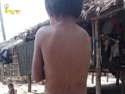 ပေါက်တောမြို့နယ် သဲခုံကျေးရွာတွင် သောက်သုံးရေ မသန့်ရှင်းမှုကြောင့် ကလေးငယ်များအပါအဝင်  ရွာသားတချို့ အရေပြားရောဂါများဖြစ်ပွားနေ