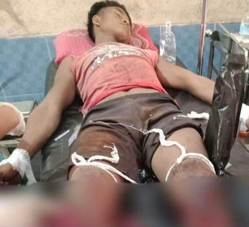 မြောက်ဦးနယ်တွင် ထင်းခုတ်သွားသည့် ခမီးလူငယ်တစ်ဦး မိုင်းနင်းမိပြီး ခြေထောက်တစ်ဖက်ပြတ်